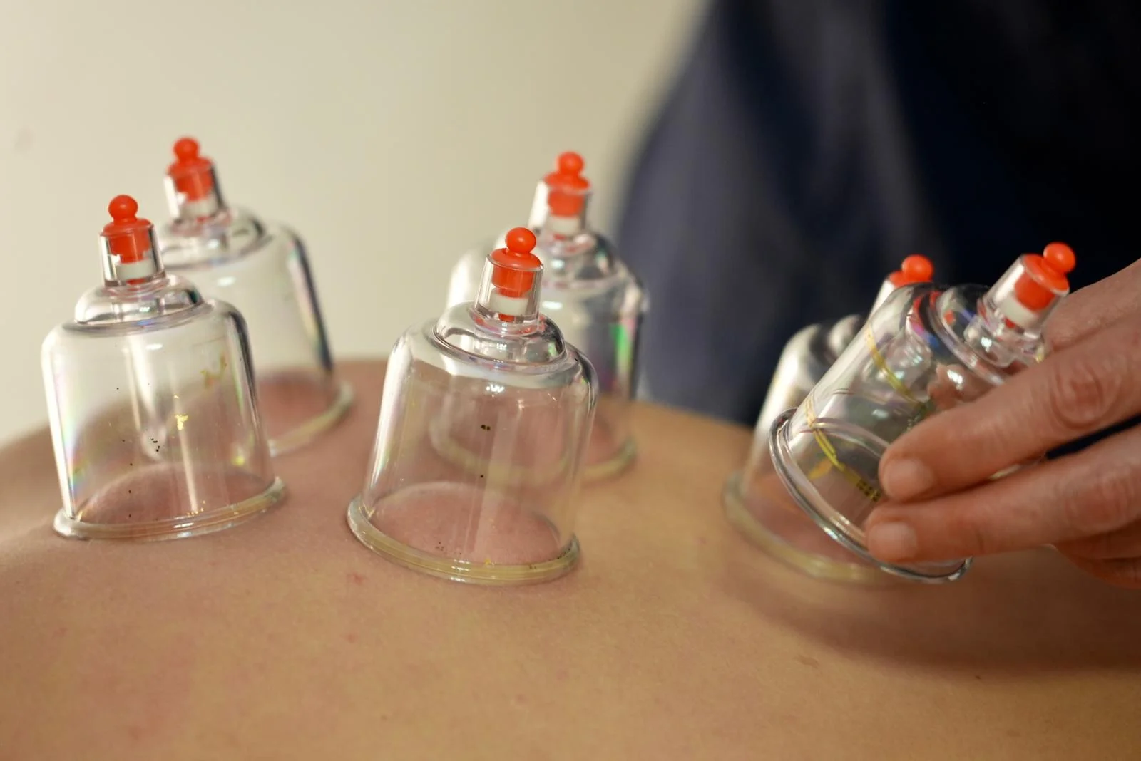 Ventouses - Soin par succion en Médecine Traditionnelle Chinoise Séance de ventouses sur le dos pour stimuler la circulation sanguine et énergétique