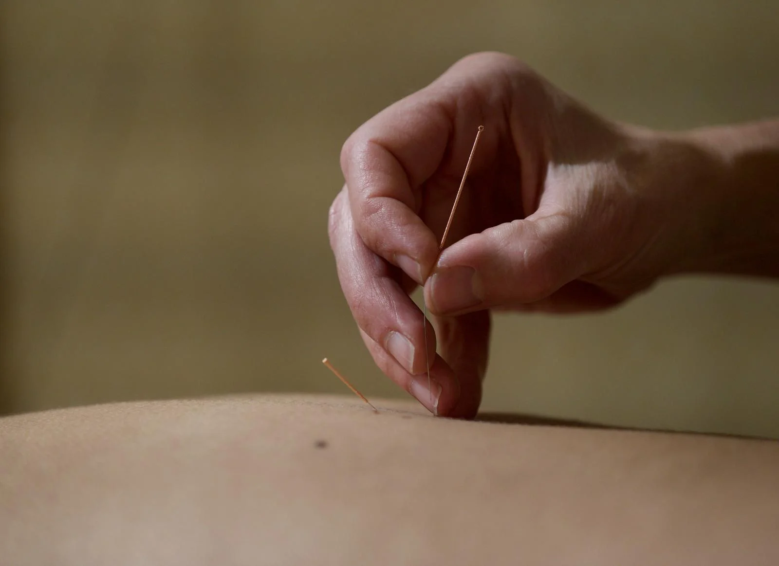 Praticienne en médecine traditionnelle chinoise réalisant une séance d'acupuncture à Barcelonnette